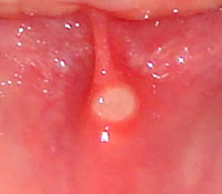 treating aphthous ulcers