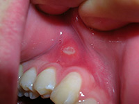 Canker sores are not contagious
