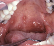 Canker sores are small whitish ulcers on the inside of the mouth