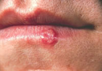cold sores are also called herpes or fever blisters