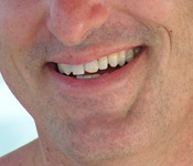 What is a canker sore - round or oval, white or yellowish flat lesion inside mouth.