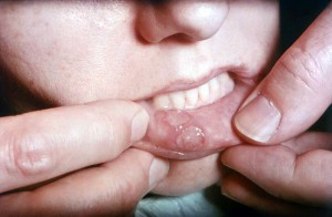 canker sores are not viral and not contagious