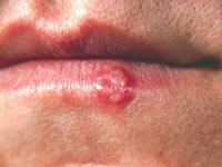 cold sores are viral in nature.