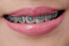 braces rubbing against the cheek or tongue can cause canker sores
