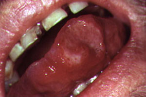 how long do mouth sores last