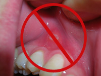get rid of your canker sore fast with these tips